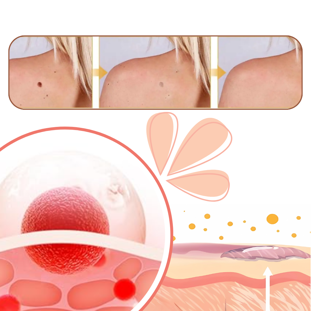 Traitement non invasif des excroissances - Ozerty