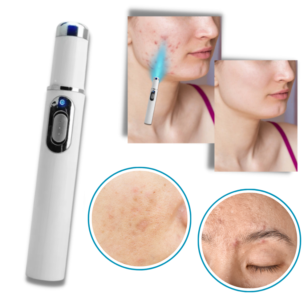 Stylo Laser Pour élimination Taches Brunes, Grains De Beauté, Tatouages - Appareil De Soin Cutané
